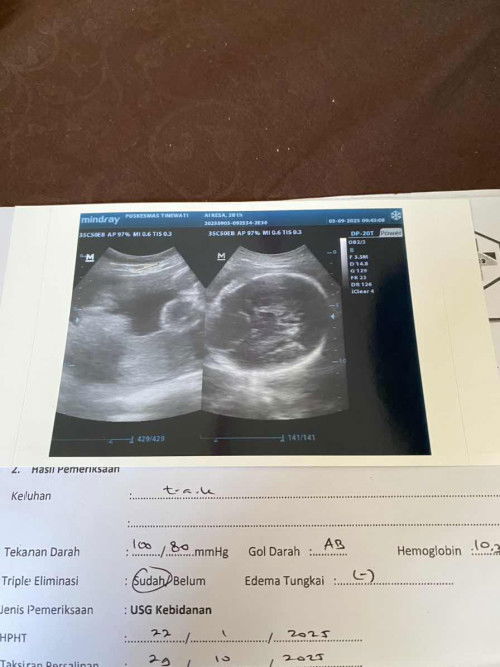 Kepala janin peyang dan ketuban agak banyak