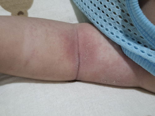 น้องมีผดขึ้น ข้อผับแดง ทายาหาย แปปๆก็กลับมาเป็นอีก ผดผื่น อะไรคะ