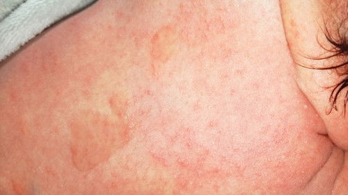 muncul bintik" ruam dikulit bayi apakah karena alergi?kita mertua karena terkena air asi apakh bnar?