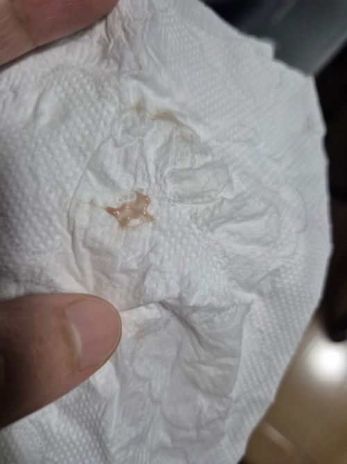 Normal po ba ang ganitong discharge sa buntis?