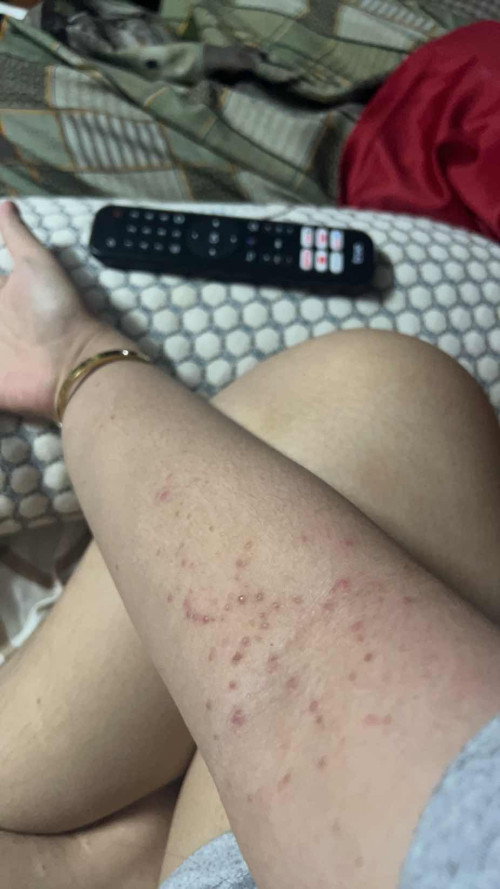 สอบถามแม่ๆนะคะ เม็ดขึ้น