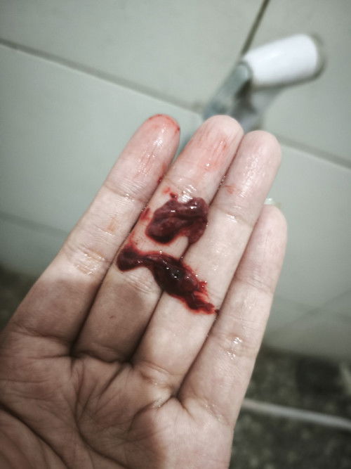 tentang gumpalan darah haid