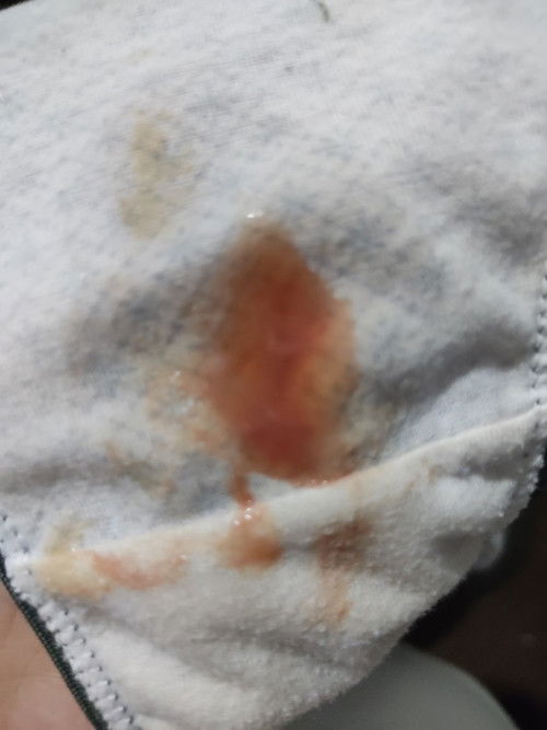 Mucus plug na po ba ito?Tips po para magdilate ang cervix?Masakit lang po balakang ko pero tolerable