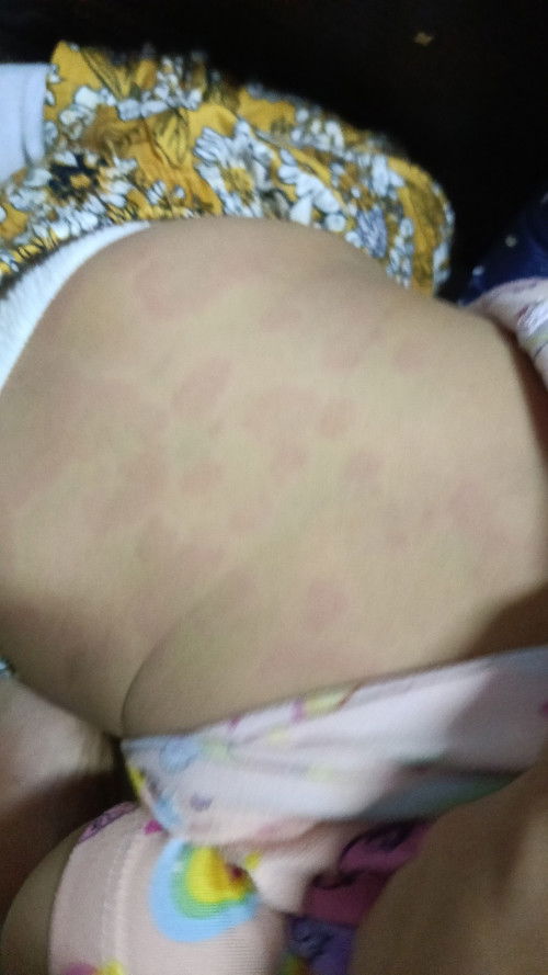 Hives lang po kaya ito