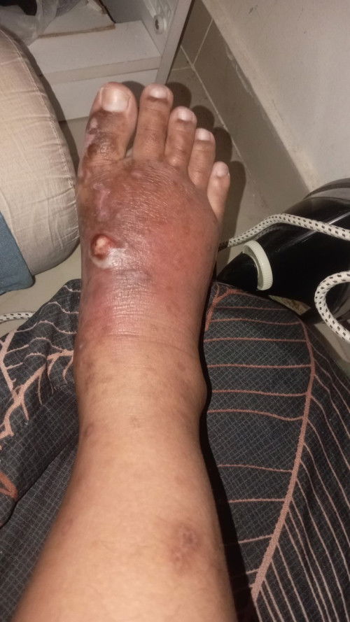 Kaki bengkak merah, Normal ke?