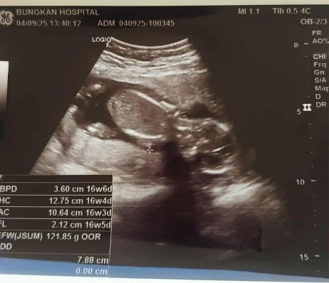 อายุครรภ์ 16 Week กว่าๆ เมื่อวานหมอนัดอัลตราซาวด์ เพศลูก หมอบอกว่าอาจจะผู้ชาย อาจจะนะๆ ยังไม่ชัวร์