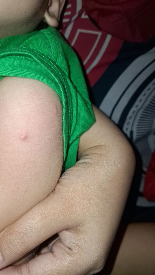 Muncul bentol² kecil di kulit anak