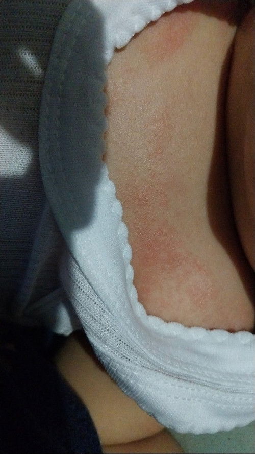 merah pada kulit