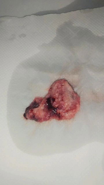 mana satu janin? gugur 8w