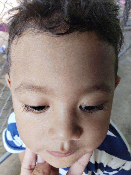 ผื่นแบบนี้คือผื่นอะไรค่ะ