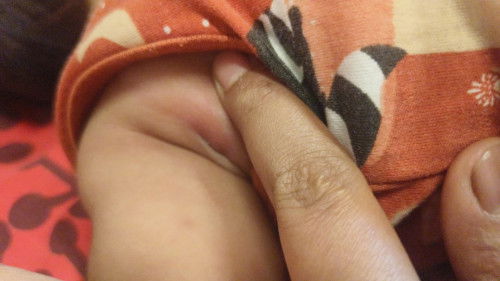 Agak benjol di ketiak bayi