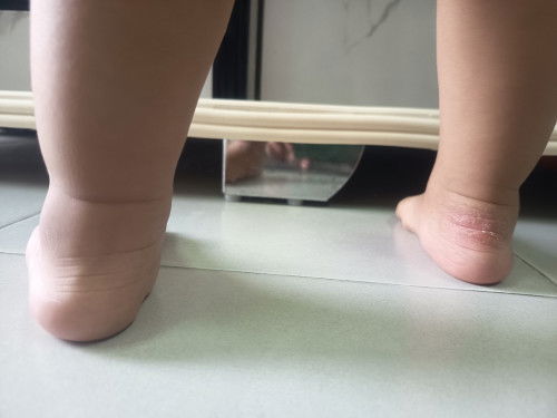 Kaki anak saya kenapa ye