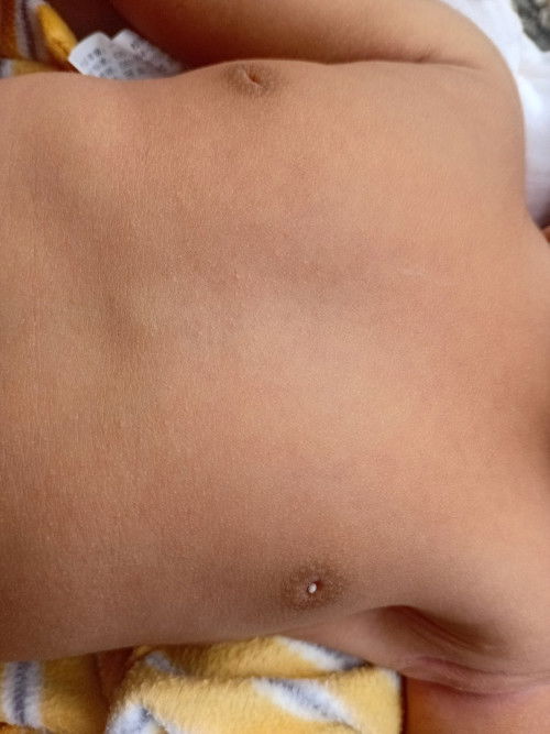White sa nipple ni baby girl