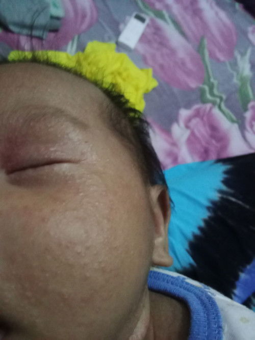 Muka bruntusan