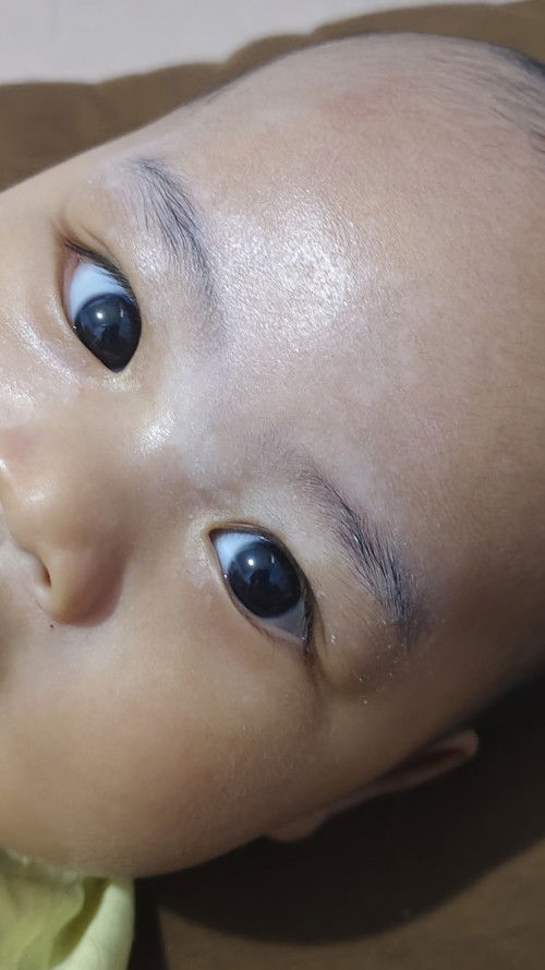 Putih2 di wajah bayi dan beruntusan