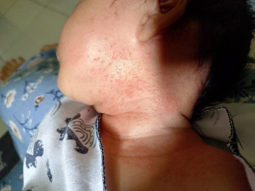 Ruam pada bayi