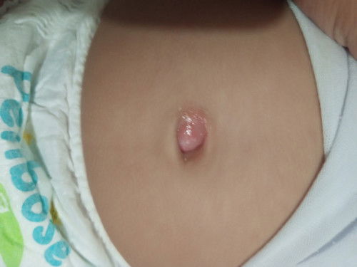 5 months na po Ang baby ko pero Yung pusod hanggang Ngayon ninyo pa magaling. Ano po pwding gawin?