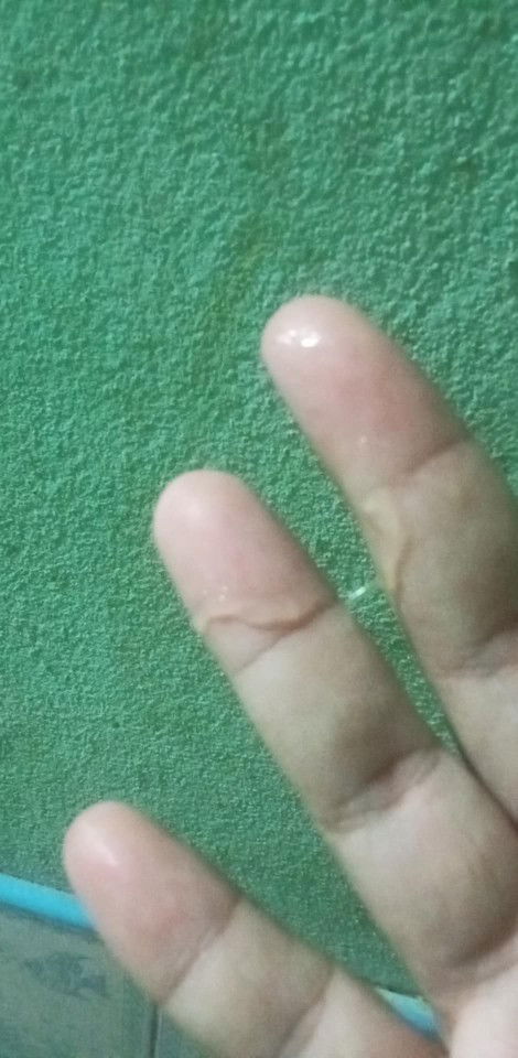 39วีคมีมูกไสๆแบบนี้ถืกว่าใกล้คลอดรึยังค่ะ