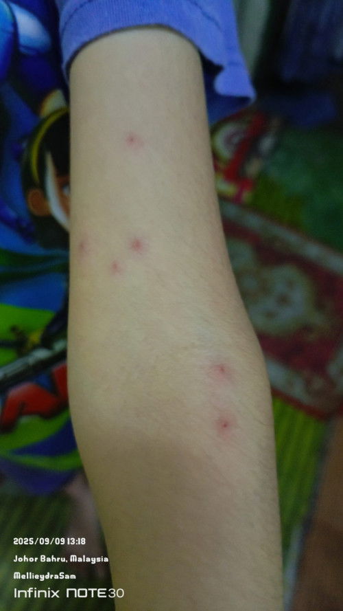Gatal tp dkt bintik tu mcm berair... Mommies taw x apa? Anak ckp gatal, dy xgaru
