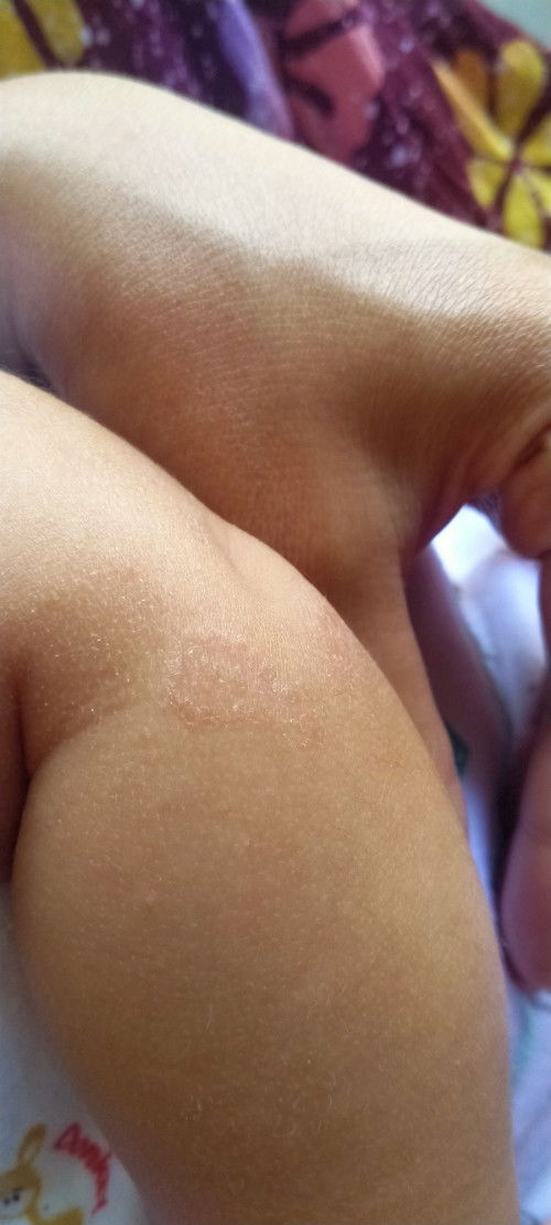 Merah pada kulit bayi