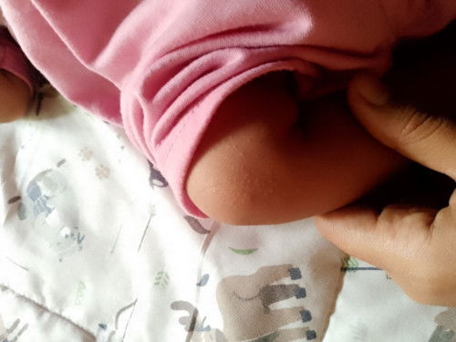Bruntusan di lutut umur 2 bulan