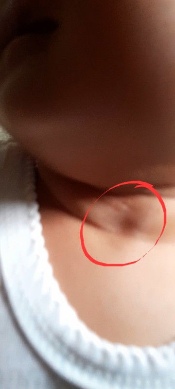 Bayi kelihatan sesak,seperti mengi juga leher sama dada cekung saat nangis