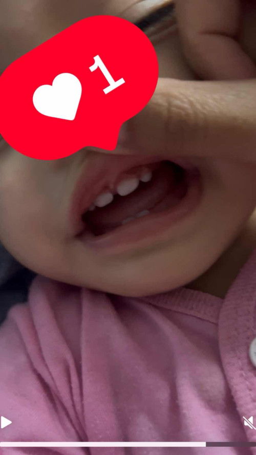 Kalau gigi dan gusi baby rupa mcmni normal ke?