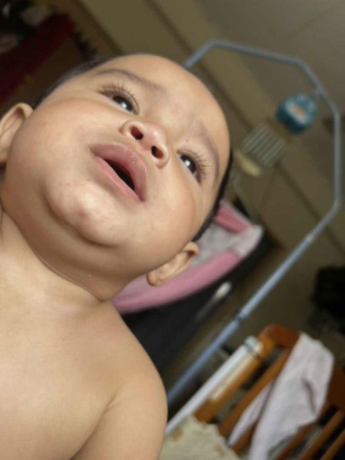 Hi mommy.. sapa yg pernah ada pengalaman baby kena HFMD..ni tanda awal HFMD ke?