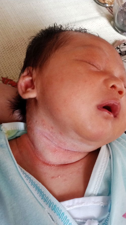 Bruntus pada leher bayi