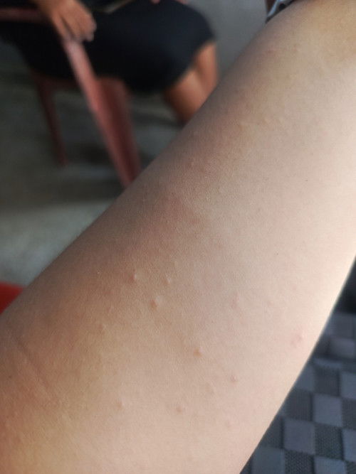 muncul bentol² sebadan