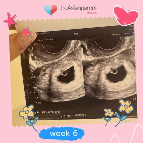 แม่ๆท่านไหน ไปอัลตราซาวด์เจ้าจิ๋วแล้ว มาอัพเดทกันครับ❤️👶🏻👧🏻