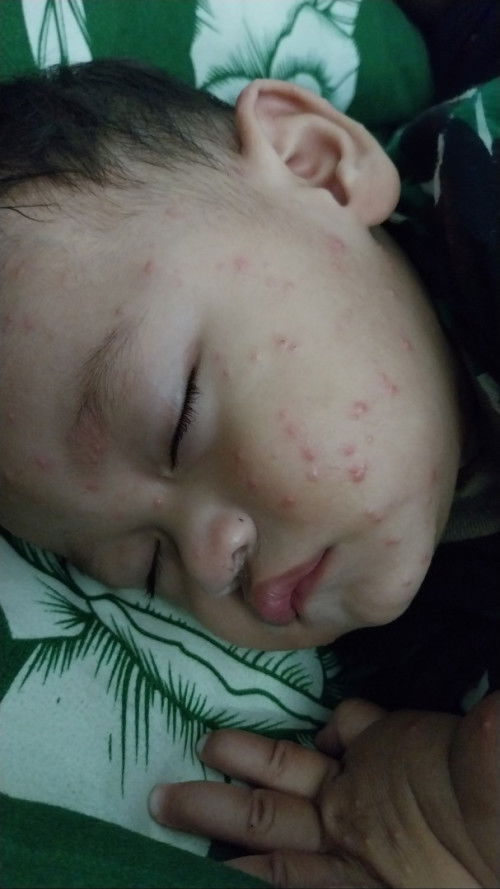 Bintik2 merah pada anak
