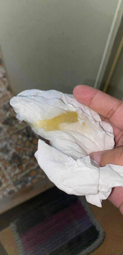 อายุครรภ์ 38+2 week