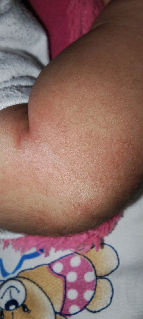 Nagka pula buong katawan ni baby pagkatapos bakunahan ng Penta 2 at PVC 2