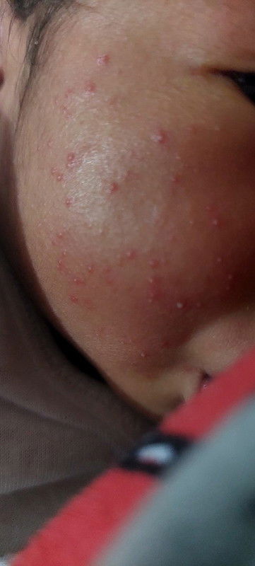 Baby acne newbown