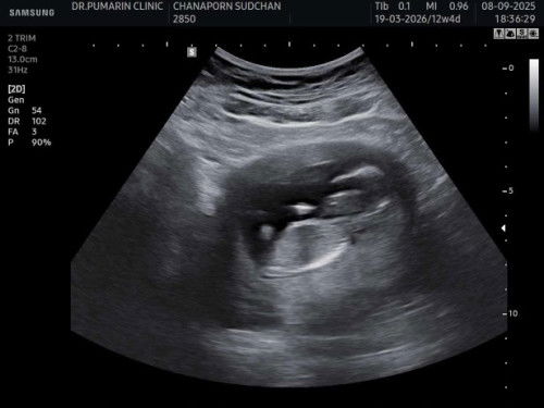 ลูกคนแรก อายุครรภ์ 13สัปดาห์4วัน