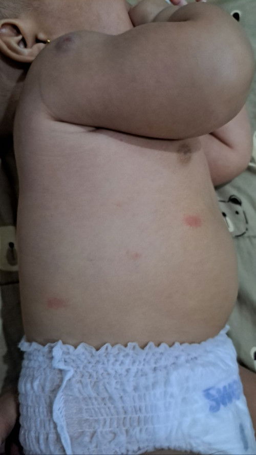 Ruam merah di kulit bayi
