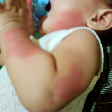 Maaf mau tanya bunda anak nya ada yang ngalamin kaya anak ku ga ya gtel"gini sampe pas merah ini knp