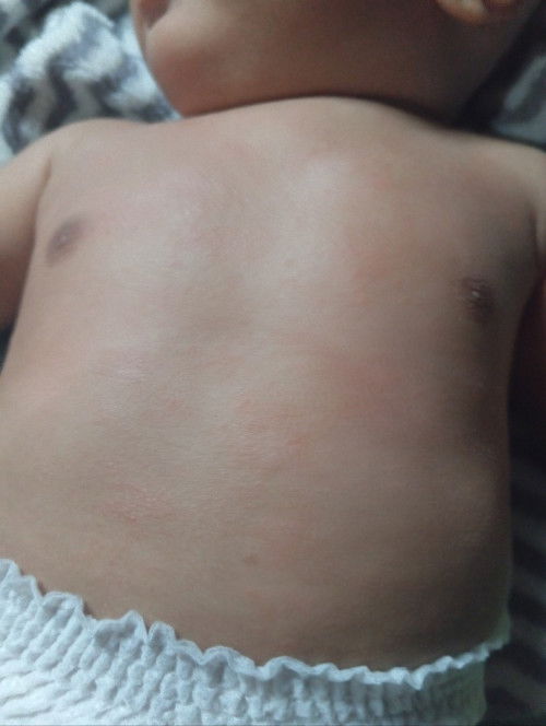 merah" pada dada bayi