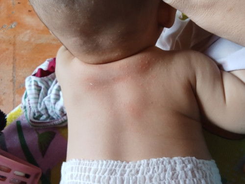 bintik dibelakang punggung bayi