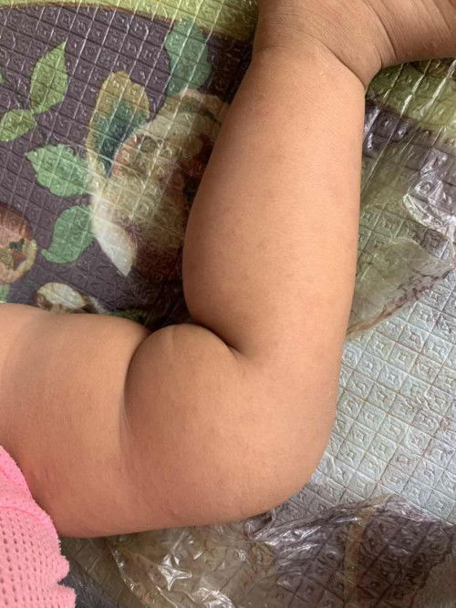 น้องแพ้รึเปนผืนค่ะ