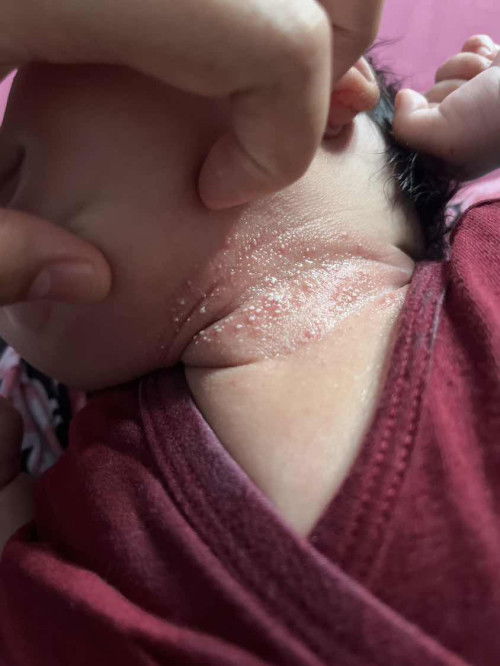 Bintik putih di leher bayi bun