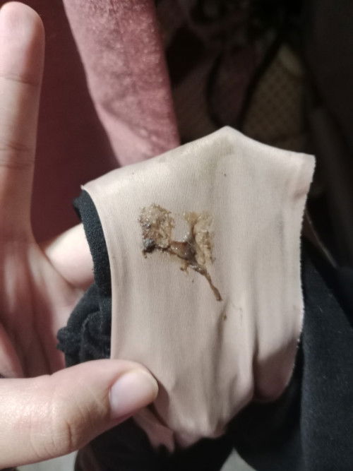 Mucus plug