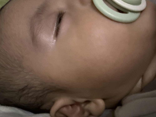 Baby 3 buln start garu garu kepala sampai merahh..i