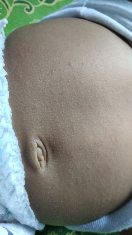 bintik2 di perut bayi