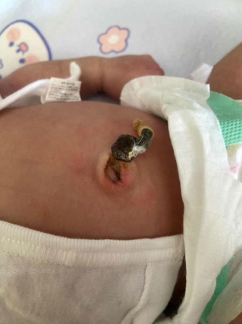 เหมือนมีน้ำอยู่ตรงโคลนสะดือ แบบนี้ผิดปกติมั้ยคะ ต้องดูแลยังไง🙏