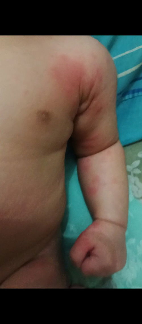 Bun baby saya baru 40 hari tapi ini 2 hari kemarin muncul bintik² merah di sekitar tangan kaki wajah