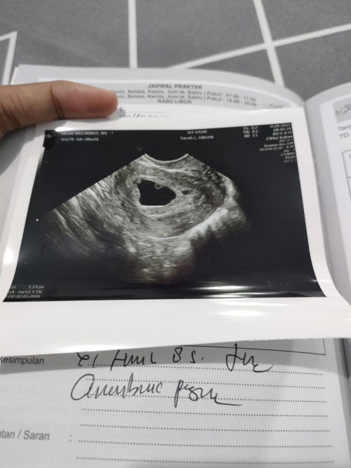 PCOS atau tidak‼️