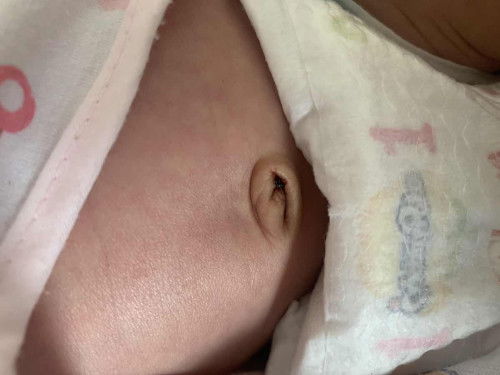 ทารก16วัน เลือดออกสะดือ