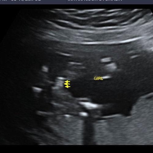 scan baby girl